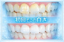 ココホワイトニング(coco whitening)