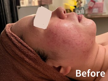 ダイヤモンド リーエンダ(Diamond leende)/クレイハーブピーリング