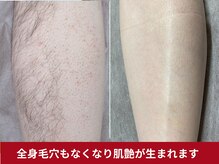 美容脱毛専門サロン エピラージュ 新宿店(Epilage)/全身肌が綺麗になります