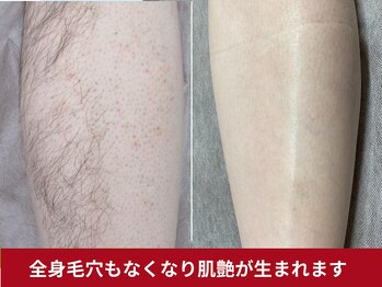 美容脱毛専門サロン エピラージュ 新宿店(Epilage)/全身肌が綺麗になります