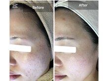 モカ 天王寺店(MOKA)/剥けない　ハーブピーリング 艶