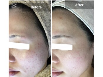 モカ 天王寺店(MOKA)/剥けない　ハーブピーリング 艶