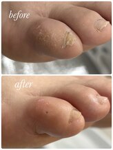 ペディラボ 荻窪店(Pedi Labo)/ネイルケア　症例（１）