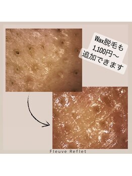 フルーヴ ルフレ(Fleuve Reflet)/Wax脱毛で黒ずみ解消！