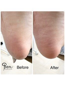 ネイルアトリエ ボン(nail atelier bon)/足裏角質ケア