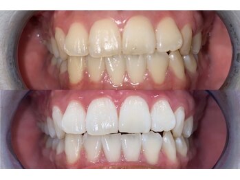 ホワイトニング専門店 WHITENING BEAUTY 光の森店【3月14日OPEN(予定)】/【Before After】