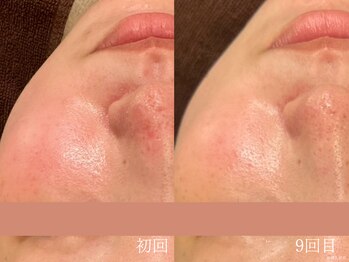 ウォーム(warm)/乾燥/敏感肌/赤み/フェイシャル