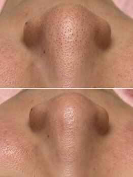 ヴィアス(Vias)の写真/【徹底毛穴つるんと引き締め】毛穴特化型美容液で皮脂汚れ分解・浮かせ吸引！一回で感動の毛穴レスへ