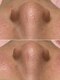 ヴィアス(Vias)の写真/【徹底毛穴つるんと引き締め】毛穴特化型美容液で皮脂汚れ分解・浮かせ吸引！一回で感動の毛穴レスへ