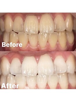 ホワイト 福岡天神店(WHITE)/ホワイトニングビフォーアフター