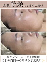 メイリー(MEILI)/ヒト幹細胞50＋エクソソーム導入