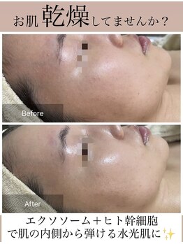 メイリー(MEILI)/ヒト幹細胞50＋エクソソーム導入