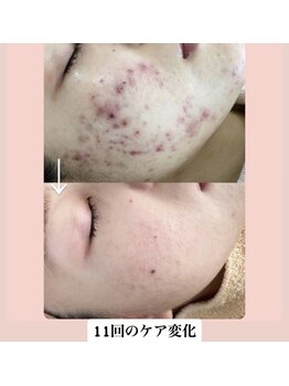 スキンハピネス(skinhappiness)/お顔ハーブピーリング(ハード)