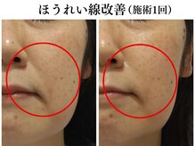 ブレリアントサロン 池袋店(brillant salon)/【40代】SAIBOWセラム(施術1回)