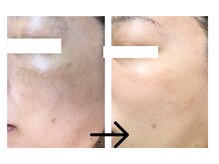 コトハ(cottha)/エルモサハーブピーリング