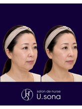小顔・脂肪コントロール専門 salon de nurse U.sona～松本店～/【顔造形】50代脂肪分解症例