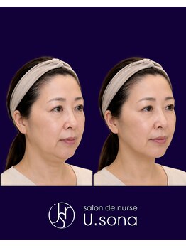 小顔・脂肪コントロール専門 salon de nurse U.sona～松本店～/【顔造形】50代脂肪分解症例