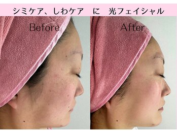 Cスキンケアクリニック 麻布店/光フェイシャルBeforeAfter