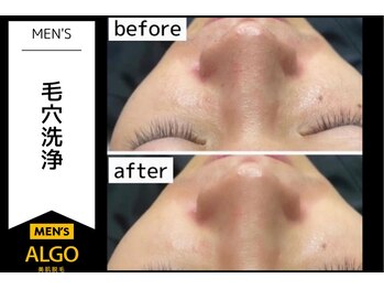 アルゴ 越前店(ALGO)/メンズ 毛穴洗浄+光脱毛