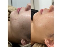 ダリア(Dahlia)の雰囲気(人気施術【10代・20代編】毛穴・ニキビ殺菌♪プラズマシャワー★)