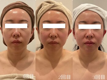 ユーフォリア グロウ(euphoria glow)/{ 骨入り小顔矯正 3回 }