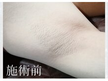 サロンドウルス(salon de ours)/メンズ　ワキ脱毛☆