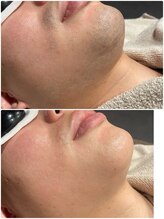 グロー(GLOW)/メンズヒゲ脱毛