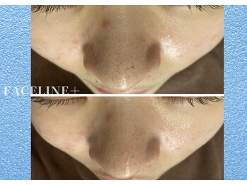 シンメトリー 銀座店/毛穴のお悩み一掃！