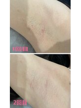 ルプリュシュ ルフレ(Le plus reflet)/ワキ脱毛!