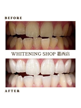 ホワイトニングショップ 葛西店/歯科提携 ホワイトニング専門店