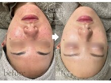 クリスティーナのピーリングでリバウンドしない肌作り！岡山市