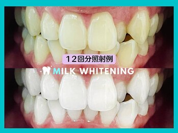 ミルクホワイトニング 長崎中央橋店(Milkホワイトニング)/◆施術例