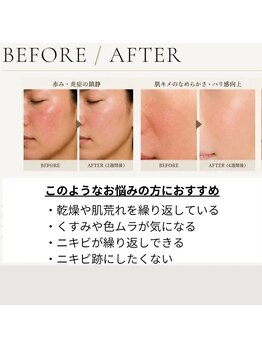 ル ボヌールの写真/ニキビ・毛穴・くすみなど、一人ひとりの肌状態に合わせて施術をセレクト。肌悩みを卒業し素肌に自信を♪