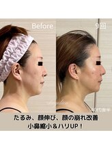 アンジェリカ(Angelica)/顔が短く！オデコは丸く！別人級