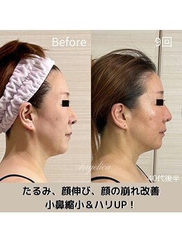 アンジェリカ(Angelica)/顔が短く！オデコは丸く！別人級