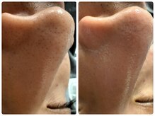 ルクシア(RUXCIA)/ビフォーアフター/毛穴洗浄1回