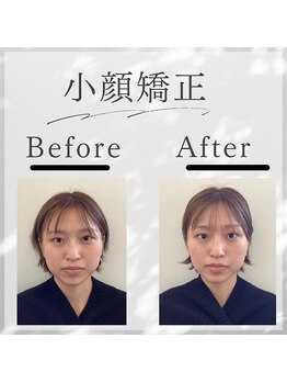 鷺沼駅前整骨院 鍼灸マッサージ院/小顔矯正やってます