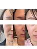 【たるみケア】諦めてていたたるみがスッキリ！リフトアップでほうれい線減！