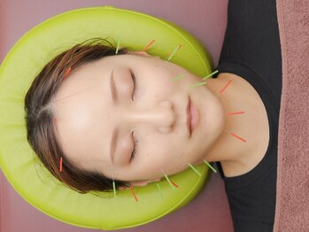 かんざき鍼灸接骨院の写真/顔の左右差/むくみ/たるみを改善！美容鍼で内側から整えます◎リフトアップ効果も！初めての方も大歓迎♪