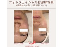リピーター様も多い光フェイシャル。お肌でお悩みの方へ。