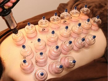 鍼灸院ワタナベコウヘイ(Watanabe Kohei)の写真/【全身にカッピング?】1度受けたらわかる!肩こりには”カッピング”血流改善で疲れ/冷え性などのお悩みに◎