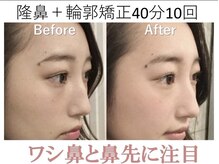 ラプリ 梅田店(Raplit)/隆鼻＋輪郭矯正40分10回