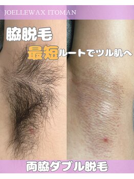 ジョエルワックス 沖縄糸満店(JOELLE WAX)/脇脱毛