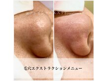 フワットン(Fouatons)の雰囲気（【最新毛穴ケア】人気の毛穴エクストラクションをご体感ください）