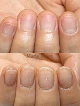 マリーロール 梅田店(Marie Laure)/自爪育成/深爪矯正/ネイルケア