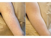 モネ(monet)/【グリンピール】二の腕プツプツ