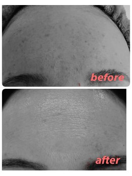 アズ(AZU)/40代before after