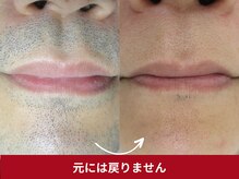 美容脱毛専門サロン エピラージュ 新宿店(Epilage)/ヒゲ脱毛元には戻りません！