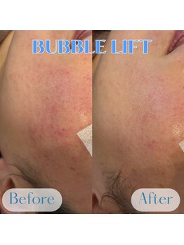 バブルビューティー(Bubble beauty)/LDM水玉リフティング