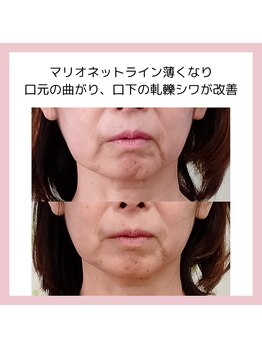 目元 口元のたるみ 眉間シワ改善専門サロン/口元のたるみを改善したい方向け